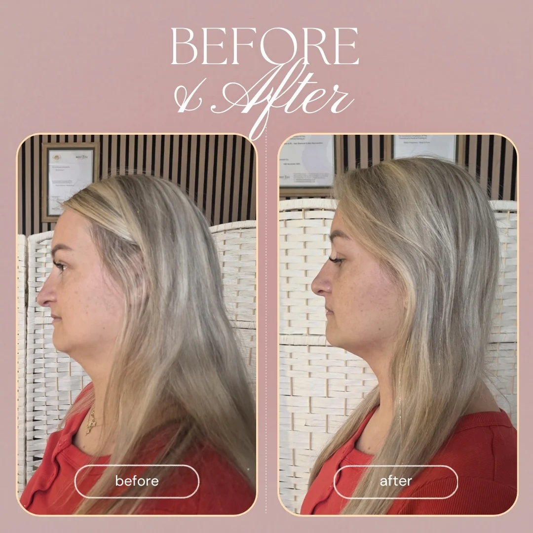 Onda Pro Coolwaves treatment at HADA Aesthetics, Leigh-on-Sea & Essex (3)